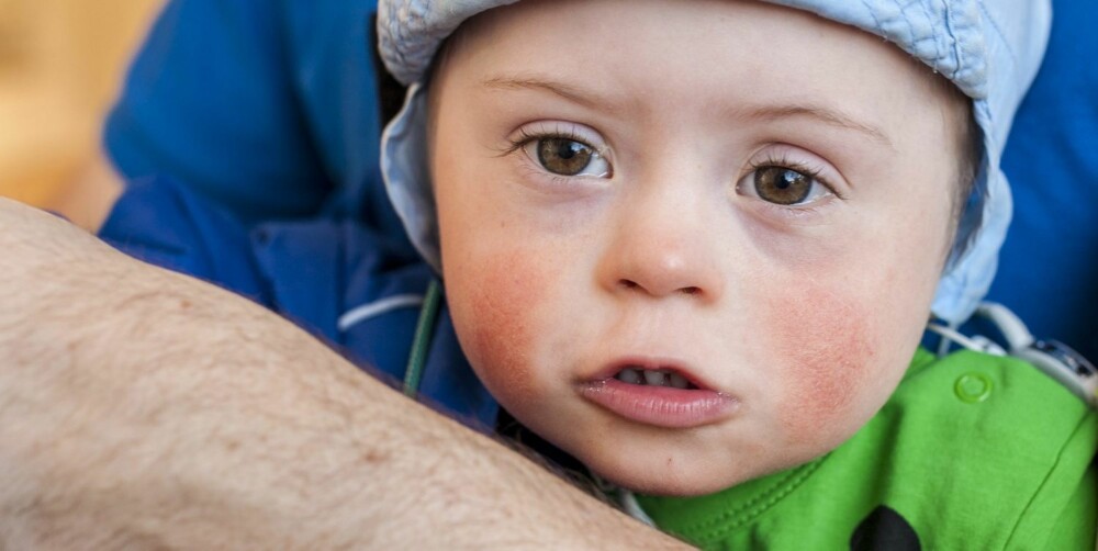 DOWNS SYNDROM: - Jeg liker ikke begrepet "annerledes barn". Annerledes enn hva? Lauritz er et barn med Downs syndrom. Bedre å kalle ham det! mener mamma Lill Østbøll, som forteller om hverdagen til en familie med Downs-barn i bloggen Mulighetenesmor.blogg.no. DOWNS SYNDROM: - Jeg liker ikke begrepet "annerledes barn". Annerledes enn hva? Lauritz er et barn med Downs syndrom. Bedre å kalle ham det! mener mamma Lill Østbøll, som forteller om hverdagen til en familie med Downs-barn i bloggen Mulighetenesmor.blogg.no.