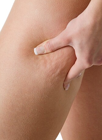 FETT: Cellulitter dannes av fett i det innerste hudlaget. FETT: Cellulitter dannes av fett i det innerste hudlaget.