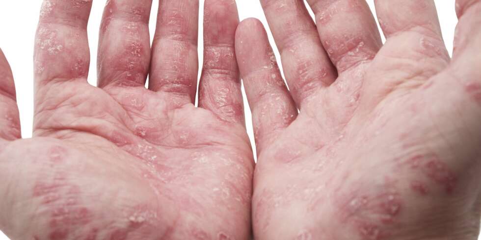 UTSLETT: Psoriasis er en kronisk hudsykdom med betennelse i huden og røde, skjellende utslett. FOTO: Thinkstockphotos UTSLETT: Psoriasis er en kronisk hudsykdom med betennelse i huden og røde, skjellende utslett. FOTO: Thinkstockphotos
