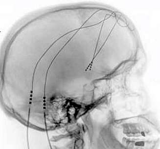 VÅR DIGITALE HJERNE: Tvangslidelser og andre mentale probelemer kan nå korrigeres ved å sende elektriske impulser til hjernen. Dette er en utprøvd metode for pasienter med Parkinsons. Nå vil forskere finne ut om sykelig overvektige også kan ha hjelp av inngrepet. VÅR DIGITALE HJERNE: Tvangslidelser og andre mentale probelemer kan nå korrigeres ved å sende elektriske impulser til hjernen. Dette er en utprøvd metode for pasienter med Parkinsons. Nå vil forskere finne ut om sykelig overvektige også kan ha hjelp av inngrepet.