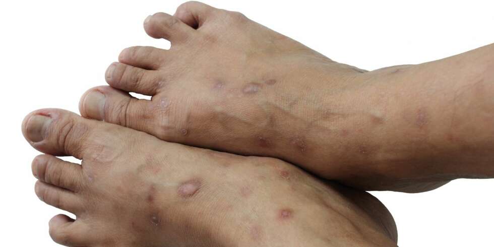 PSORIASIS: Psoriasis er en kronisk hudsykdom. PSORIASIS: Psoriasis er en kronisk hudsykdom.