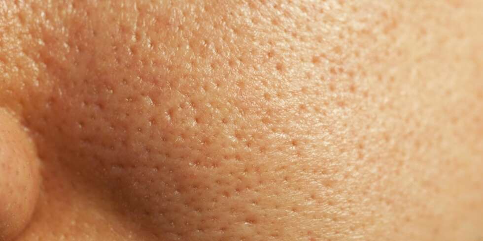 FÅ PERFEKT SOMMERHUD: Mange som sliter med grov hud vet ikke hvordan de skal gå fram for å bli kvitt problemet. Det er imidlertid mange metoder som virker. FÅ PERFEKT SOMMERHUD: Mange som sliter med grov hud vet ikke hvordan de skal gå fram for å bli kvitt problemet. Det er imidlertid mange metoder som virker.