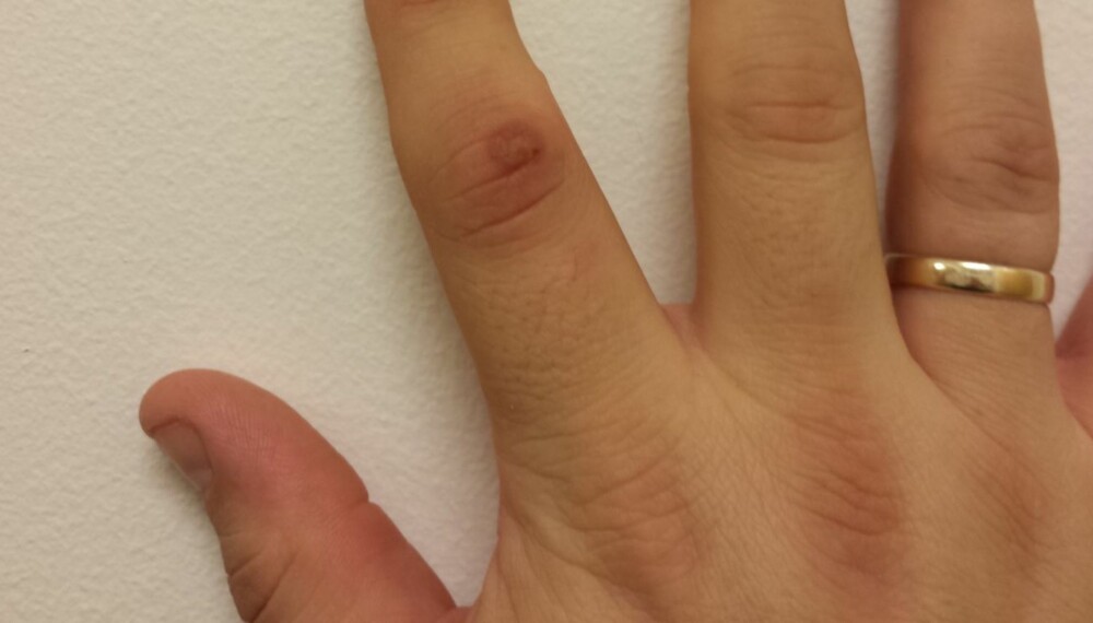 VERKEFINGER: En liten vorte førte til en hoven og vond verkefinger. VERKEFINGER: En liten vorte førte til en hoven og vond verkefinger.