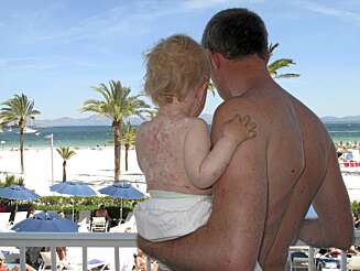 KLØR: Vannkoppene som Idun fikk på Mallorca klødde og væsket så mye at familien måtte få kløestillende medisin og talkum for å tørke ut blemmene. KLØR: Vannkoppene som Idun fikk på Mallorca klødde og væsket så mye at familien måtte få kløestillende medisin og talkum for å tørke ut blemmene.