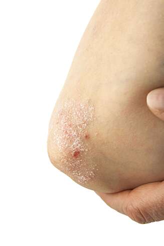 SAMMENHENG: Utbredelse av utslettet varierer avhengig av hvilken type psoriasis du har og hvor alvorlig rammet du er. Nå viser nye studier at hudsykdommen kan ha en sammenheng med hjerte –og karsykdommer. FOTO: Thinkstock SAMMENHENG: Utbredelse av utslettet varierer avhengig av hvilken type psoriasis du har og hvor alvorlig rammet du er. Nå viser nye studier at hudsykdommen kan ha en sammenheng med hjerte –og karsykdommer. FOTO: Thinkstock