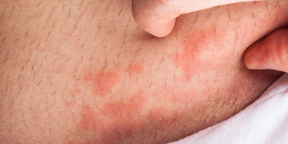 ATOPISK EKSEM: Det eksisterer ingen behandling som kan kurere atopisk eksem, men det finnes flere behandlingsmetoder som kan bedre plagene og hjelpe til med å holde sykdommen i sjakk. ILLUSTRASJONSFOTO: Colourbox ATOPISK EKSEM: Det eksisterer ingen behandling som kan kurere atopisk eksem, men det finnes flere behandlingsmetoder som kan bedre plagene og hjelpe til med å holde sykdommen i sjakk. ILLUSTRASJONSFOTO: Colourbox