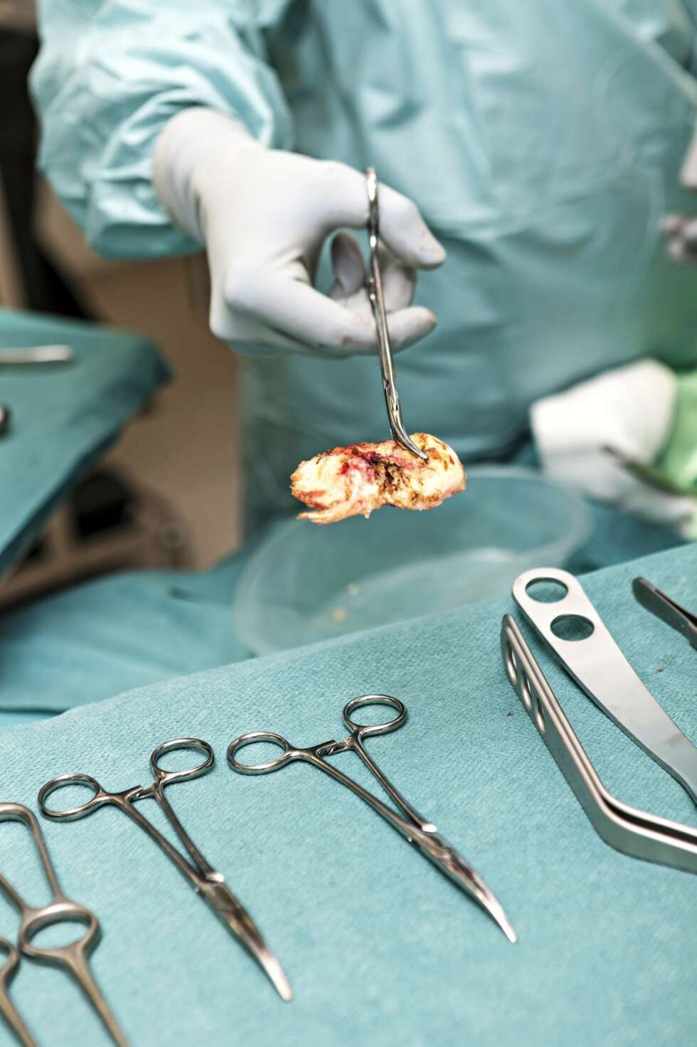 5. HER ER SKADEN: Det er denne nedslitte brusken som har gjort så vondt. Nå skal den erstattes med en menisk i plast. 5. HER ER SKADEN: Det er denne nedslitte brusken som har gjort så vondt. Nå skal den erstattes med en menisk i plast.