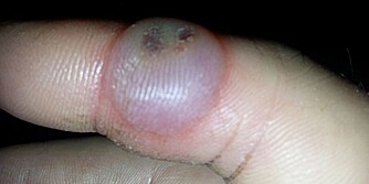 HOVEN PEKEFINGER: Også på pekefingeren fikk Eide blemmer. HOVEN PEKEFINGER: Også på pekefingeren fikk Eide blemmer.