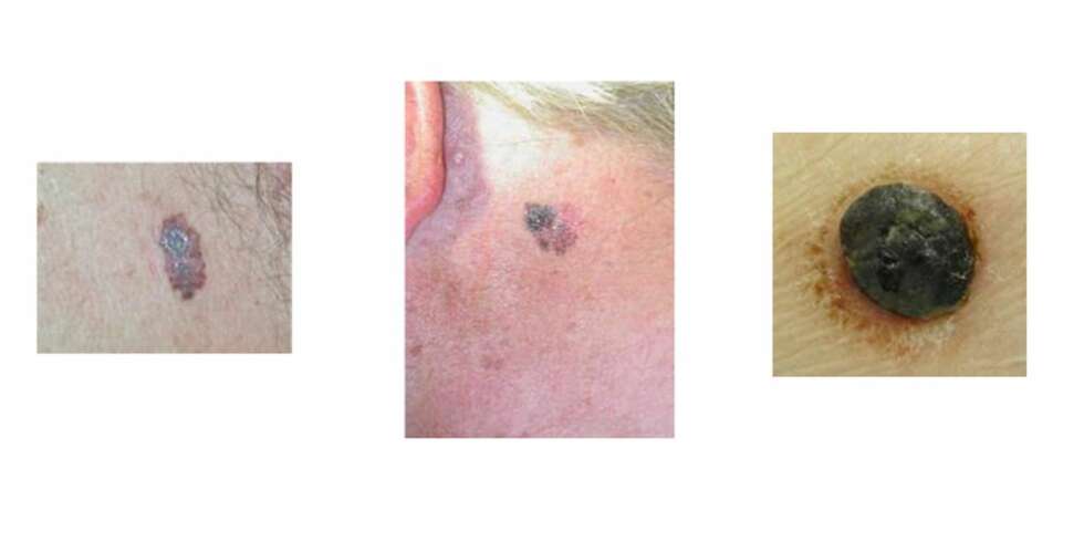 FØFLEKK-KREFT: Du kan se hvordan føflekk-kreft kan se ut her: www.euromelanoma.org/no. FOTO: Euromelanoma.org FØFLEKK-KREFT: Du kan se hvordan føflekk-kreft kan se ut her: www.euromelanoma.org/no. FOTO: Euromelanoma.org