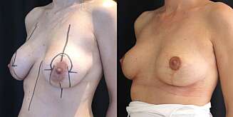 Brystløft med eget vev etter uttak av eldre implantat. Før og etter. Brystløft med eget vev etter uttak av eldre implantat. Før og etter.