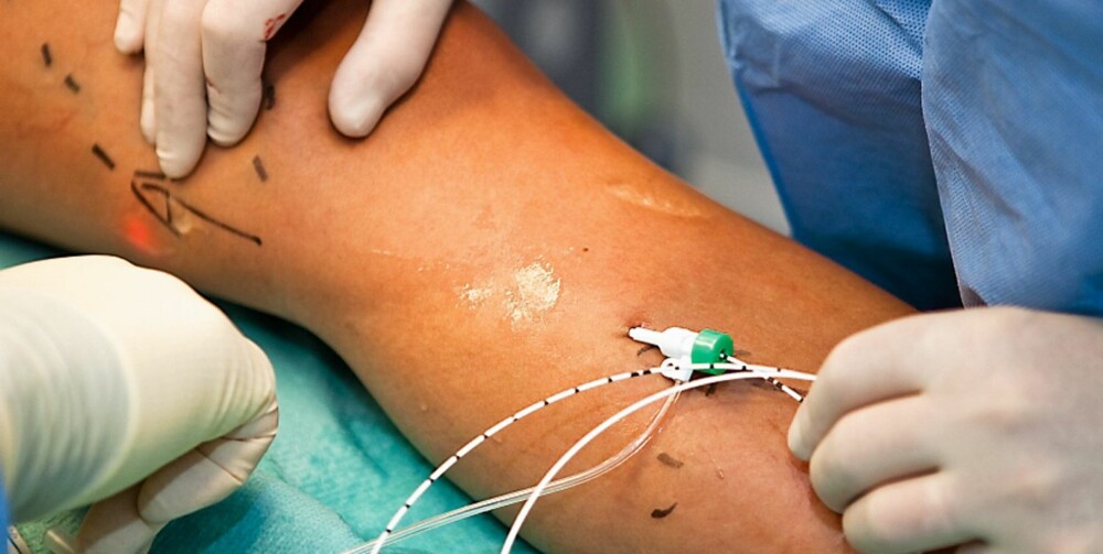 RØDT LYS: Legg merke til det røde lyset i laserfiberen som er ført inn i venen opp til kneet. Den behandlende delen brytes naturlig ned i kroppen innen seks måneder. RØDT LYS: Legg merke til det røde lyset i laserfiberen som er ført inn i venen opp til kneet. Den behandlende delen brytes naturlig ned i kroppen innen seks måneder.