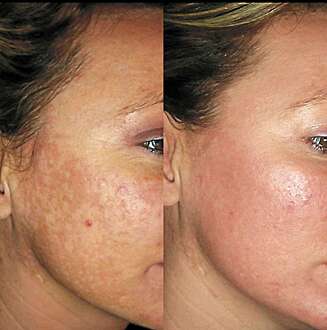 FRAXEL LASER: Mot pigmentflekker. FRAXEL LASER: Mot pigmentflekker.
