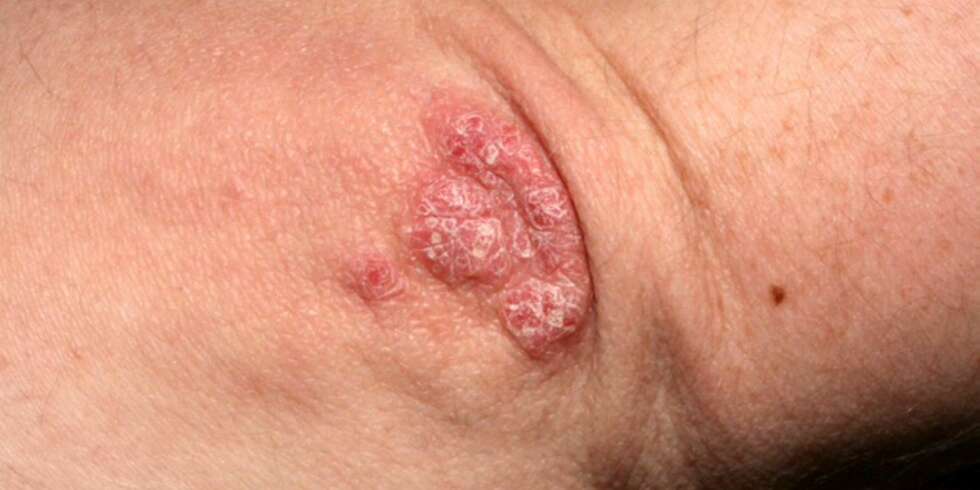 PSORIASIS: Utslettet kan være lokalisert overalt på kroppen, men det typiske er røde, skjellende plakk på strekkesidene av albuer og knær. PSORIASIS: Utslettet kan være lokalisert overalt på kroppen, men det typiske er røde, skjellende plakk på strekkesidene av albuer og knær.
