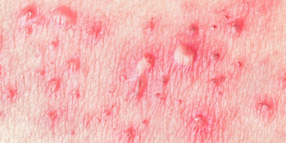 HELVETESILD: Smertene ved helvetesild kan oppleves som svært intense.
Illustrasjonsfoto: Colourbox HELVETESILD: Smertene ved helvetesild kan oppleves som svært intense.
Illustrasjonsfoto: Colourbox