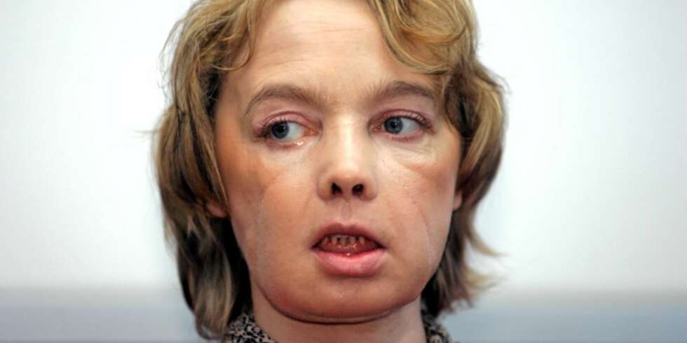 BITT AV HUND: Isabelle Dinoire var den første kvinnen i verden som fikk transplantert et ansikt etter at hun ble bitt i ansiktet av sin egen hund. Etter transplantasjonen har den franske kvinnen fått et nytt liv. BITT AV HUND: Isabelle Dinoire var den første kvinnen i verden som fikk transplantert et ansikt etter at hun ble bitt i ansiktet av sin egen hund. Etter transplantasjonen har den franske kvinnen fått et nytt liv.