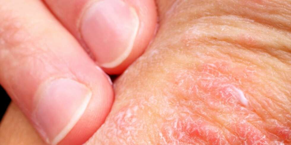 TØRRE, RØDE FLEKKER: Man kan ha psoriasisflekker over hele kroppen, men ansiktet rammes vanligvis ikke. TØRRE, RØDE FLEKKER: Man kan ha psoriasisflekker over hele kroppen, men ansiktet rammes vanligvis ikke.