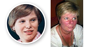 FØR: Det Berit som tenåring trodde var kviser, skulle vise seg å være hudsykdommen rosacea. Hun ble med tiden hardt rammet. Bildet til høyre viser Berit sommeren før hun startet laserbehandlingen. FØR: Det Berit som tenåring trodde var kviser, skulle vise seg å være hudsykdommen rosacea. Hun ble med tiden hardt rammet. Bildet til høyre viser Berit sommeren før hun startet laserbehandlingen.