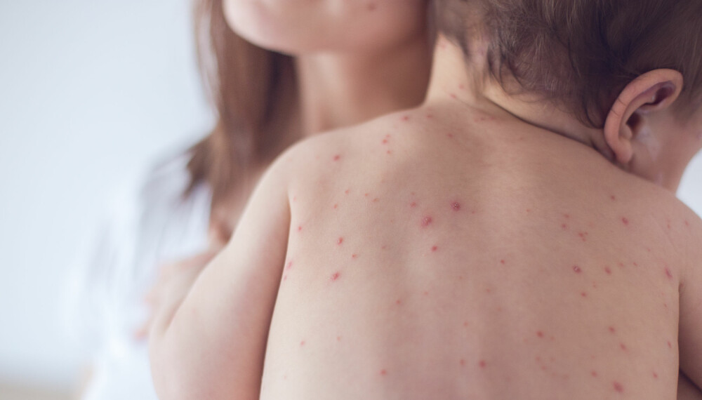 RØDE HUNDER HOS BARN: Røde hunder (rubella) hos barn, har utslett som ligner på mange andre barnesykdommer. Røde hunder er imidlertid svært sjelden i dag. RØDE HUNDER HOS BARN: Røde hunder (rubella) hos barn, har utslett som ligner på mange andre barnesykdommer. Røde hunder er imidlertid svært sjelden i dag.