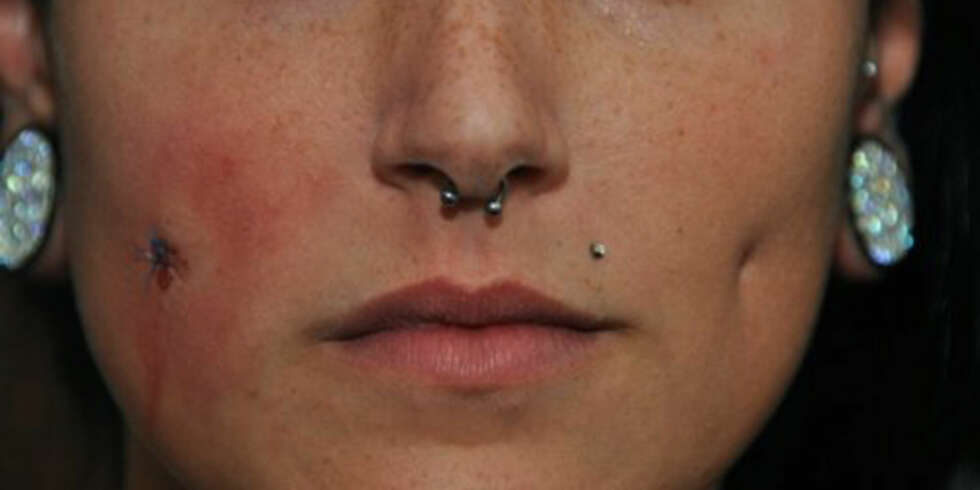 ETT ARR FIKSET: Det høyre ""smilehull-arret"" er snittet og sydd, det andre er fortsatt intakt. Slike arr oppstår når du setter piercing gjennom kinnet. ETT ARR FIKSET: Det høyre ""smilehull-arret"" er snittet og sydd, det andre er fortsatt intakt. Slike arr oppstår når du setter piercing gjennom kinnet.