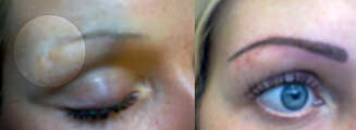 TATOVERING DEKKER OVER: En permanent makeup-tatovering kan dekke over et arr fra piercing i øyebrynet. Til venstre ser du øyebrynet før tatoveringen, og til høyre det ferdige resultatet. TATOVERING DEKKER OVER: En permanent makeup-tatovering kan dekke over et arr fra piercing i øyebrynet. Til venstre ser du øyebrynet før tatoveringen, og til høyre det ferdige resultatet.