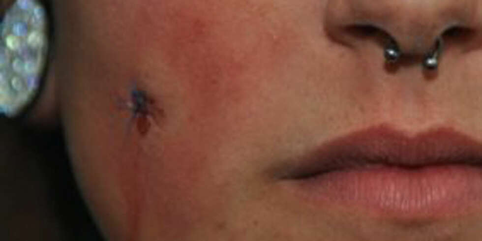 SNITTET OPP: Her er piercing-arret snittet opp og sydd igjen. Fordi piercing-arr er gjennomgående, er dette den eneste måten å fjerne arrene på. Se hele bildet lenger ned i saken. SNITTET OPP: Her er piercing-arret snittet opp og sydd igjen. Fordi piercing-arr er gjennomgående, er dette den eneste måten å fjerne arrene på. Se hele bildet lenger ned i saken.