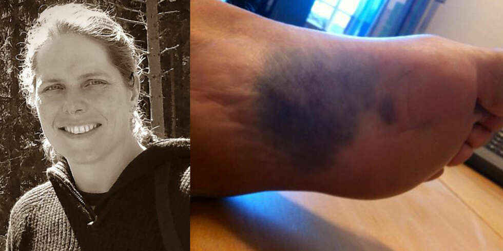 BLÅMERKER: Janne Auli (38) fra Bærum er ikke alene om å få blåmerker lett, det er noe mange opplever. Mens andre igjen, får dem sjelden. BLÅMERKER: Janne Auli (38) fra Bærum er ikke alene om å få blåmerker lett, det er noe mange opplever. Mens andre igjen, får dem sjelden.