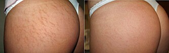 FØR OG ETTER: I følge Laserklinikken.no kan strekkmerker reduseres betydelig med laser. FØR OG ETTER: I følge Laserklinikken.no kan strekkmerker reduseres betydelig med laser.