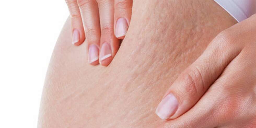 Strekkmerker kan skyldes hormonforandringene pga. graviditeten. Foto: Colourbox.no Strekkmerker kan skyldes hormonforandringene pga. graviditeten. Foto: Colourbox.no