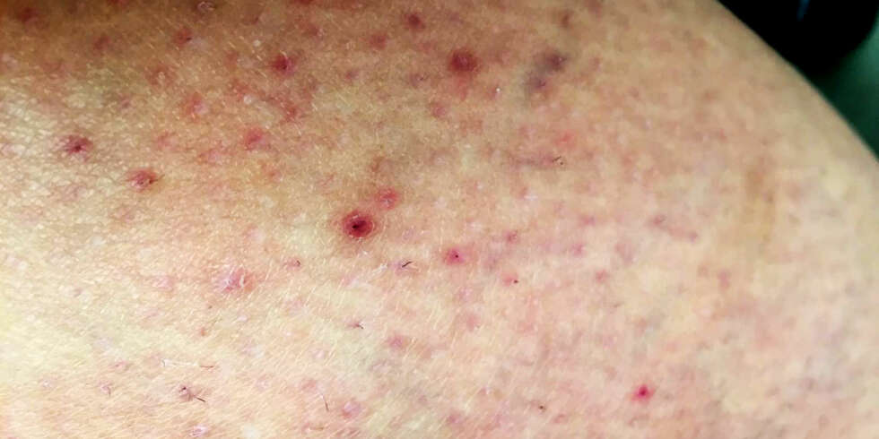INNGRODD HÅR: Slik kan resultatet bli dersom du klemmer på de røde nuppene. Noe du helst ikke bør gjøre. FOTO: Privat INNGRODD HÅR: Slik kan resultatet bli dersom du klemmer på de røde nuppene. Noe du helst ikke bør gjøre. FOTO: Privat