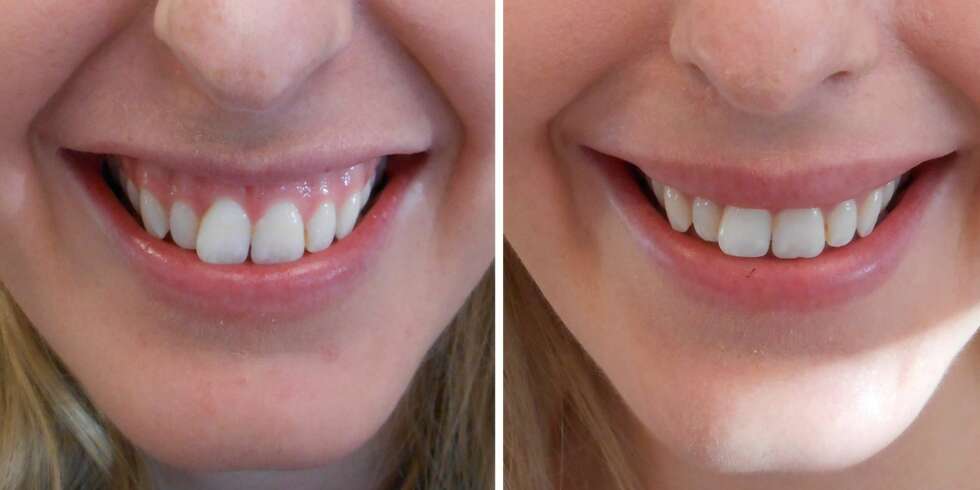 GUMMYSMILE: Michelle Fayen (25) har nettopp utført et Botox-inngrep for å unngå såkalt «gummysmile», altså en betegnelse på at du trekker overleppen høyt oppover mot nesen når du smiler, slik at mye av tannkjøttet kommet til syne. Til venstre: Før injiseringen. Til høyre: Etter Botox-inngrepet. GUMMYSMILE: Michelle Fayen (25) har nettopp utført et Botox-inngrep for å unngå såkalt «gummysmile», altså en betegnelse på at du trekker overleppen høyt oppover mot nesen når du smiler, slik at mye av tannkjøttet kommet til syne. Til venstre: Før injiseringen. Til høyre: Etter Botox-inngrepet.