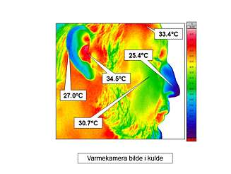FROSTSKADE: De blå områdene viser de kaldeste områdene i ansiktet når de er utsatt for kulde. Nese, ører og hake er spesielt utsatt. FROSTSKADE: De blå områdene viser de kaldeste områdene i ansiktet når de er utsatt for kulde. Nese, ører og hake er spesielt utsatt.