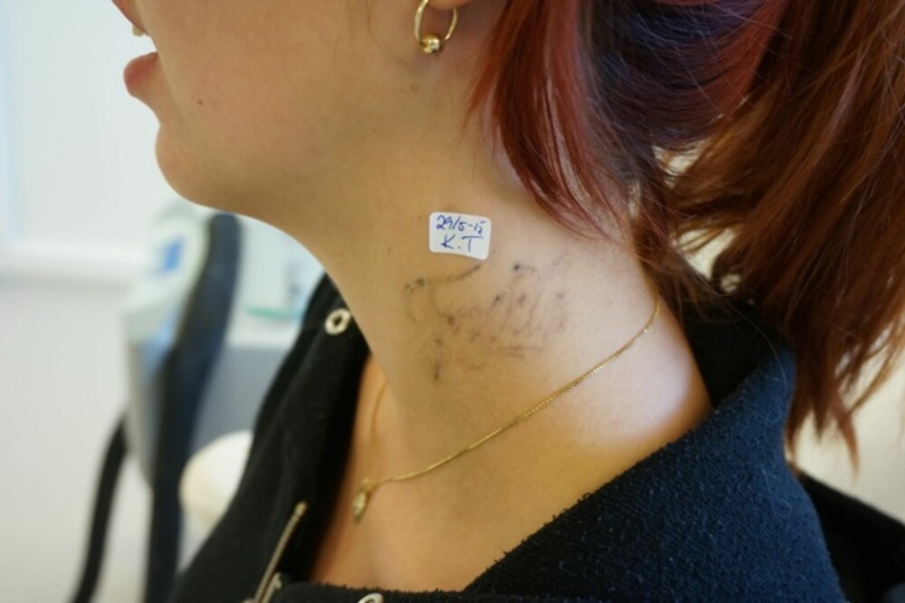 FJERNT MINNE: Mange angrer tatoveringen som ble tatt midt i den sterkeste forelskelses-rusen. Det kan koste deg dyrt i fremtiden, men det er i alle fall mulig å fjerne den betydelig. FJERNT MINNE: Mange angrer tatoveringen som ble tatt midt i den sterkeste forelskelses-rusen. Det kan koste deg dyrt i fremtiden, men det er i alle fall mulig å fjerne den betydelig.