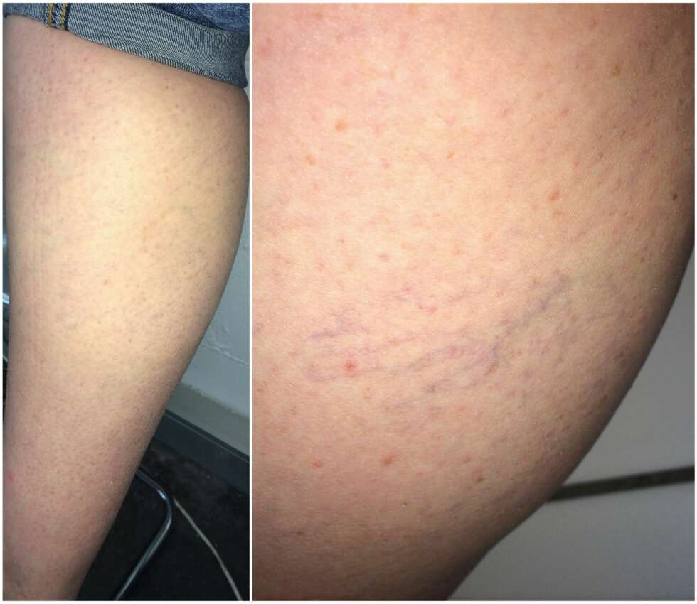 VERDT Å VENTE PÅ: Selv om det tok litt over 2 måneder var Tove strålende fornøyd med resultatet. Spindelvevåren (høyre bilde) som ble behandlet kan ikke lenger sees på benet (venstre bilde). VERDT Å VENTE PÅ: Selv om det tok litt over 2 måneder var Tove strålende fornøyd med resultatet. Spindelvevåren (høyre bilde) som ble behandlet kan ikke lenger sees på benet (venstre bilde).