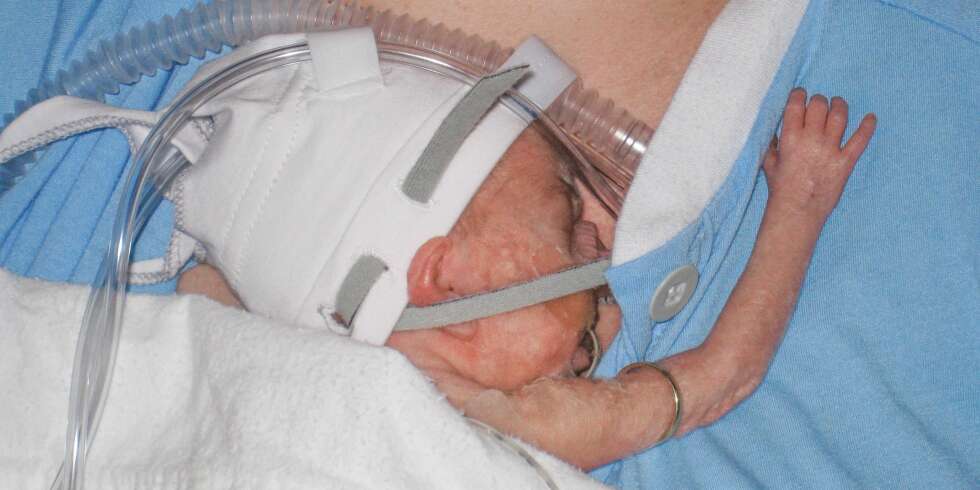 BITTE LITEN: Vårin var så tildekket av maske og ledninger at foreldrene ikke fikk se ansiktet hennes ordentlig før det var gått to måneder. BITTE LITEN: Vårin var så tildekket av maske og ledninger at foreldrene ikke fikk se ansiktet hennes ordentlig før det var gått to måneder.