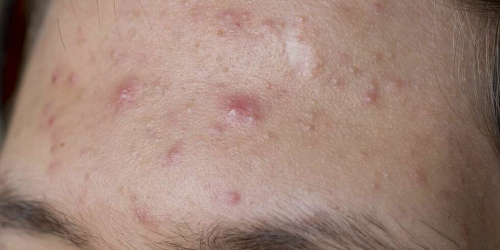 ARVELIG BETINGET: Kviser skyldes først og fremst av gener, slår hudekspertene fast. ILLUSTRASJONSFOTO: Thinkstock ARVELIG BETINGET: Kviser skyldes først og fremst av gener, slår hudekspertene fast. ILLUSTRASJONSFOTO: Thinkstock