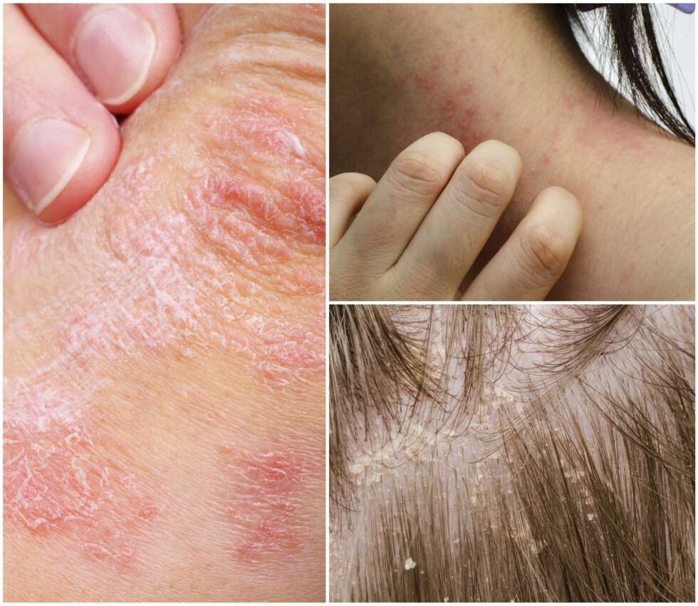 PSORIASIS: Denne kroniske hudsykdommen kan slå ut både i hodebunn - gjerne langs hårfestet, på albuer, hals og på knærne. Tror du at du har psoriasis, er det viktig å oppsøke hudlege for korrekt behandling. PSORIASIS: Denne kroniske hudsykdommen kan slå ut både i hodebunn - gjerne langs hårfestet, på albuer, hals og på knærne. Tror du at du har psoriasis, er det viktig å oppsøke hudlege for korrekt behandling.