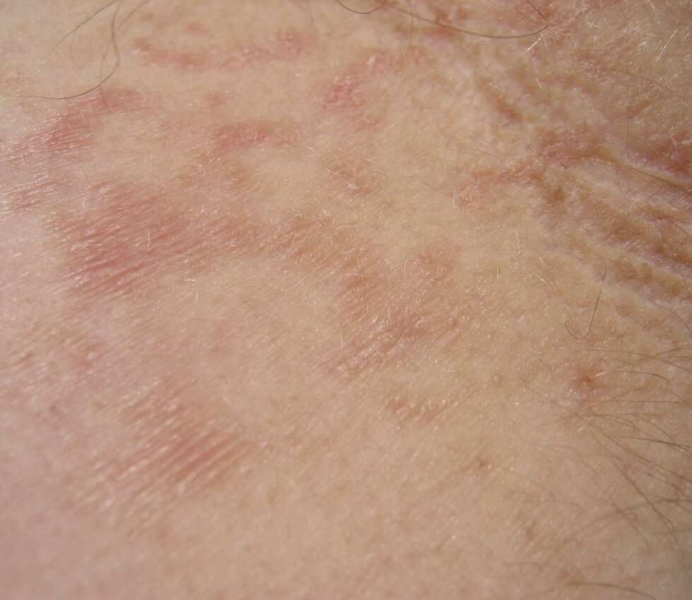 SEBOREISK EKSEM: Den største forskjellen på behandlingen av rosacea og seboreisk eksem er et soppdrepende middel. SEBOREISK EKSEM: Den største forskjellen på behandlingen av rosacea og seboreisk eksem er et soppdrepende middel.