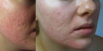 MICRONEEDLING: En populær behandling hos hudpleier er såkalt microneedling. Her er førbilde (til venstre) og etterbilde av aknearr behandling med microneedling. MICRONEEDLING: En populær behandling hos hudpleier er såkalt microneedling. Her er førbilde (til venstre) og etterbilde av aknearr behandling med microneedling.