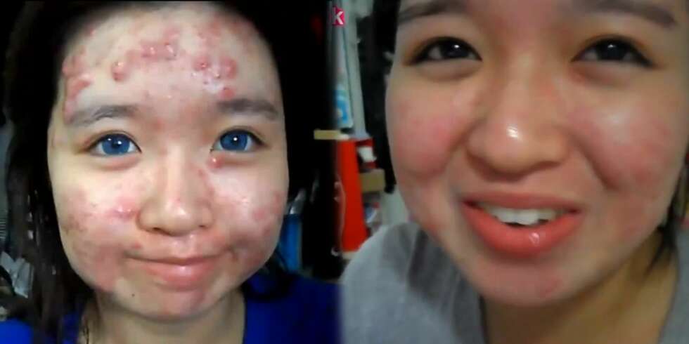 CYSTISK AKNE: Elaine Mokk er youtuberen som dokumenterte tiden før, under og etter bruken av det sterke legemiddelet Roaccutan med bilder og video. CYSTISK AKNE: Elaine Mokk er youtuberen som dokumenterte tiden før, under og etter bruken av det sterke legemiddelet Roaccutan med bilder og video.