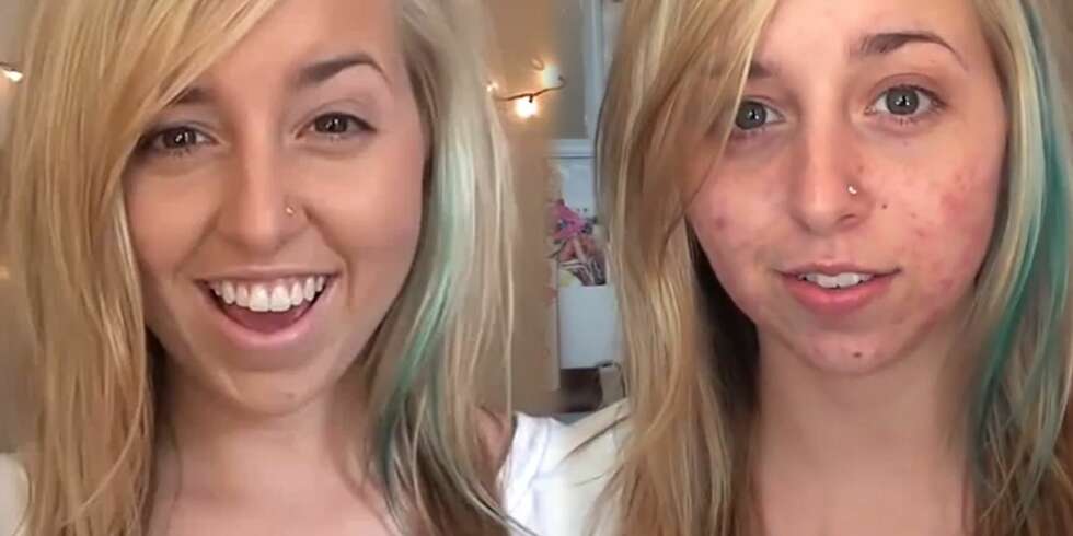 SMINKE REDDER DAGEN: Ingen tvil om at makeup kan redde dagen når man sliter med akne. Denne youtuberen, Iheartmakeup92, har også en populær sminkevideo der hun viser hvordan hun legger concealer og foundation for å få så jevn og fin hud som mulig. SMINKE REDDER DAGEN: Ingen tvil om at makeup kan redde dagen når man sliter med akne. Denne youtuberen, Iheartmakeup92, har også en populær sminkevideo der hun viser hvordan hun legger concealer og foundation for å få så jevn og fin hud som mulig.