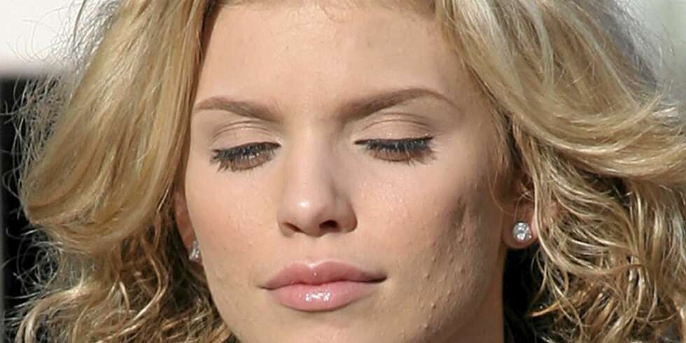 90210-stjernen AnnaLynne McCord er talskvinne for kvisenettstedet AcneHeroes.com. 90210-stjernen AnnaLynne McCord er talskvinne for kvisenettstedet AcneHeroes.com.