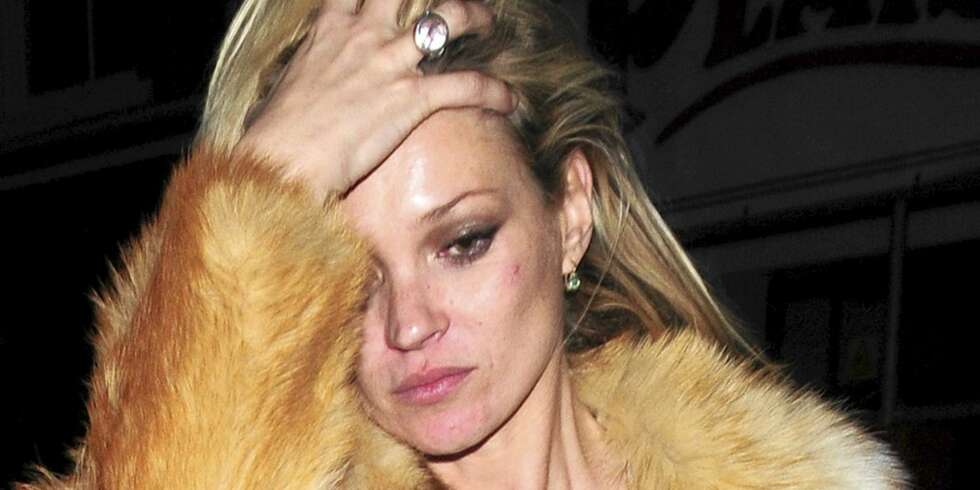 HUDPROBLEMER: Kate Moss så ganske annerledes ut enn hun gjør på de glossy magasin-forsidene. HUDPROBLEMER: Kate Moss så ganske annerledes ut enn hun gjør på de glossy magasin-forsidene.
