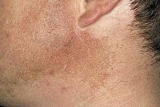 MENN: Både menn og kvinner får pigmentflekker. Særlig er alkoholholdige after shave en risikofaktor for menn. Alkohol gjør huden enda mer utsatt for pigmenteringer. MENN: Både menn og kvinner får pigmentflekker. Særlig er alkoholholdige after shave en risikofaktor for menn. Alkohol gjør huden enda mer utsatt for pigmenteringer.