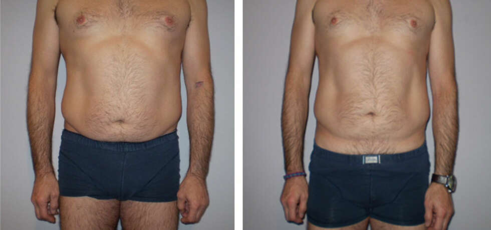 FAST I FISKEN: Med Contour er en ny metode for bodyslimming for det lille ekstra på flanker/midje/mage/lår. Før/etter behandling. FAST I FISKEN: Med Contour er en ny metode for bodyslimming for det lille ekstra på flanker/midje/mage/lår. Før/etter behandling.