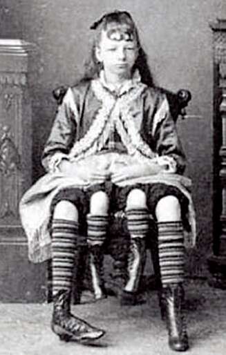 Myrtle Corbin (1868-1928) var meget populær, reiste rundt med en rekke av tidens store sirkus og tjente så mye som 450 dollar i uka. Hun ble presentert som ¿den firbeinte jenta¿, men det ene beinparet hørte til en ikke utviklet tvilling. Myrtle giftet seg med en lege og fikk fem barn. Ifølge legenden hadde hun to forplantningssystemer og fødte barn fra begge. Myrtle Corbin (1868-1928) var meget populær, reiste rundt med en rekke av tidens store sirkus og tjente så mye som 450 dollar i uka. Hun ble presentert som ¿den firbeinte jenta¿, men det ene beinparet hørte til en ikke utviklet tvilling. Myrtle giftet seg med en lege og fikk fem barn. Ifølge legenden hadde hun to forplantningssystemer og fødte barn fra begge.