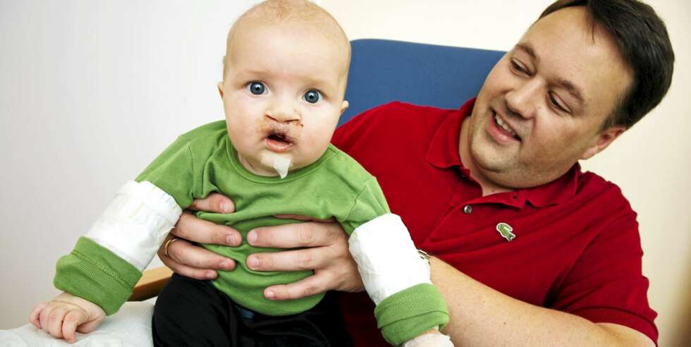 MARIUS OG PAPPA: Marius er blitt 5 måneder. Etter den andre operasjonen får han skinner over albuleddet for å hindre ham i å ta på såret. Pappa gir ham mat med en spesialflaske. MARIUS OG PAPPA: Marius er blitt 5 måneder. Etter den andre operasjonen får han skinner over albuleddet for å hindre ham i å ta på såret. Pappa gir ham mat med en spesialflaske.