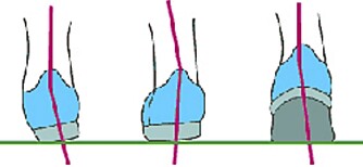 NORMALPRONASJON NORMALPRONASJON