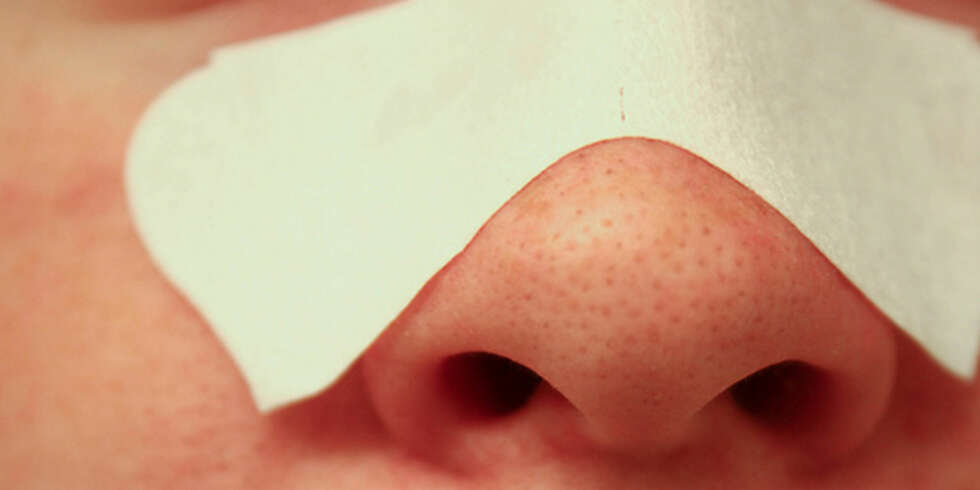 VEKK, VEKK: Mange plages med sorte prikker på nesen og i T-sonen. Men for all del ikke klem disse ut selv. VEKK, VEKK: Mange plages med sorte prikker på nesen og i T-sonen. Men for all del ikke klem disse ut selv.