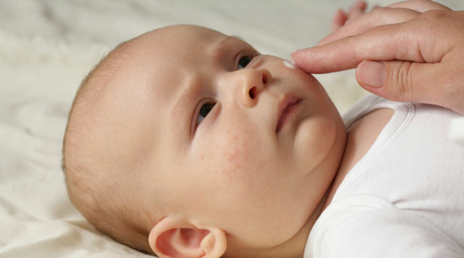HORMONUTSLETT HOS BABY: Opptil 20 prosent av alle spedbarn vil få et hormonutslett. Det er vanligvis helt ufarlig. FOTO: Gettyimages.com HORMONUTSLETT HOS BABY: Opptil 20 prosent av alle spedbarn vil få et hormonutslett. Det er vanligvis helt ufarlig. FOTO: Gettyimages.com