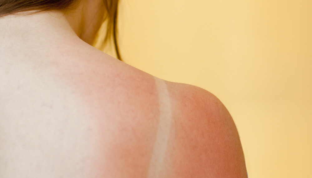SOLBRENT: Solbrenthet kan være både ubehagelig og smertefullt. Vi gir deg forebyggende råd og tips til behandling. FOTO: Getty Images SOLBRENT: Solbrenthet kan være både ubehagelig og smertefullt. Vi gir deg forebyggende råd og tips til behandling. FOTO: Getty Images